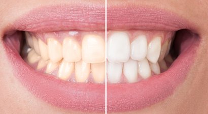 Zahnschmelzschonende und rentable Bleachingmethoden