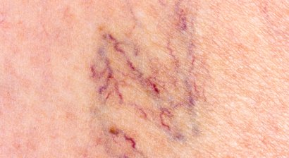 Therapie von Besenreisern