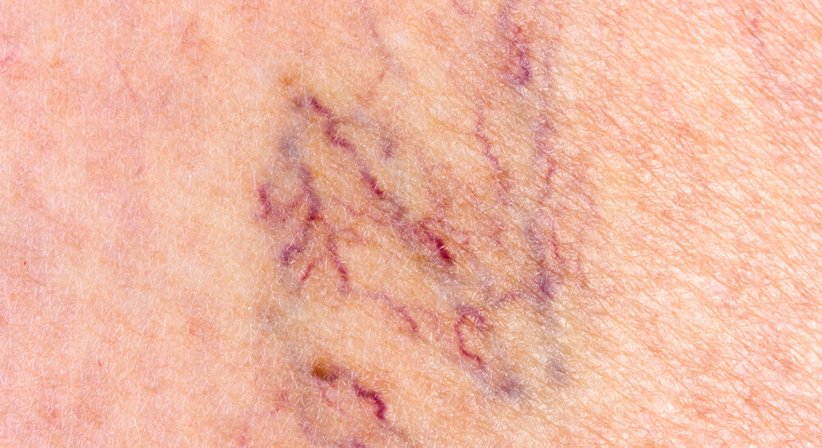 Therapie von Besenreisern - Dr. Michael Mellek - Gefäßchirurg Guntramsdorf 2353