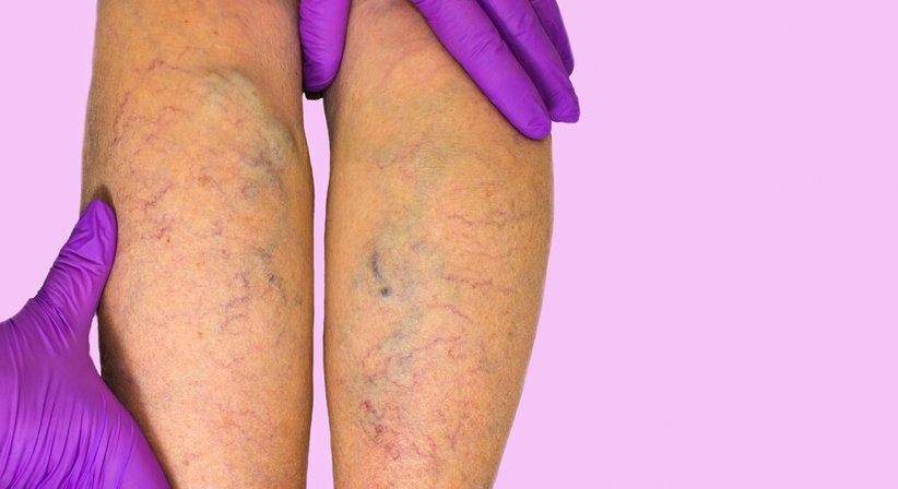 Radiofrequenztherapie - Dr. Michael Mellek - Gefäßchirurg Guntramsdorf 2353