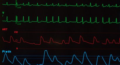 Endovaskuläre Aortensanierung / EVAR (endovaskuläre Aortenreparatur)