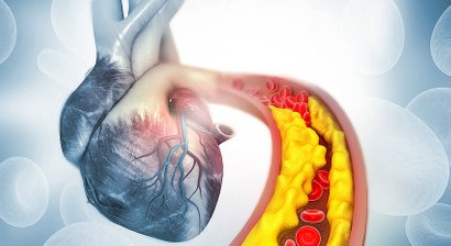Fettstoffwechselstörungen