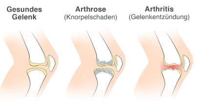 Nicht-entzündliche Gelenkerkrankungen
