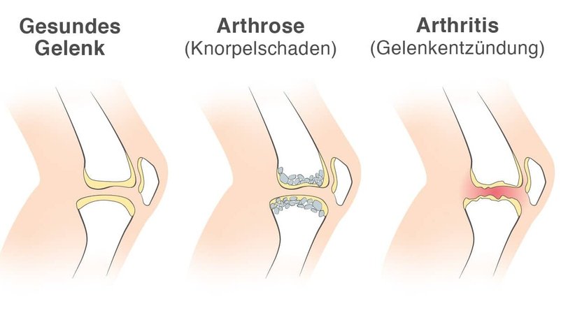 Nicht-entzündliche Gelenkerkrankungen - Priv.-Doz. Dr. Christian Muschitz - Internist Wien 1010