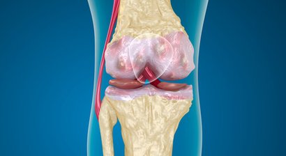 Knochenmarködem / Stressfraktur