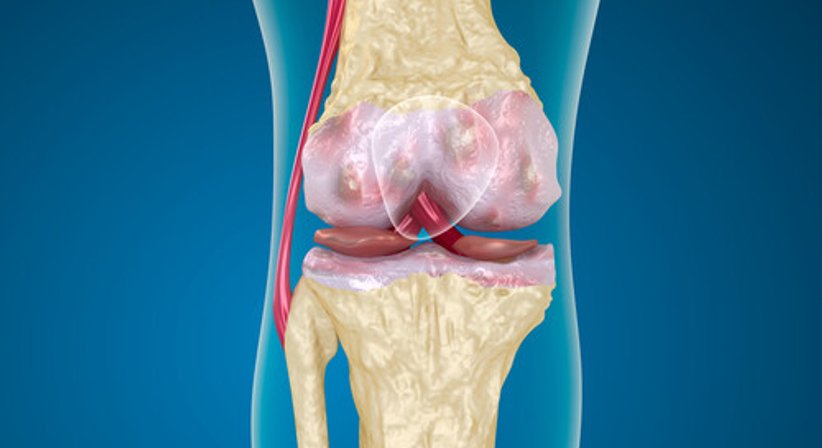 Knochenmarködem / Stressfraktur - Priv.-Doz. Dr. Christian Muschitz - Internist Wien 1010
