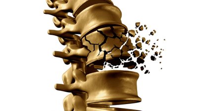 Osteoporose (Knochenschwund)