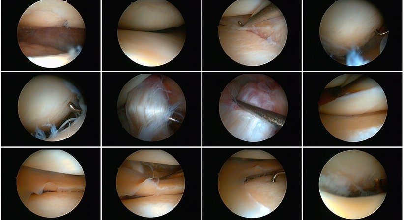 Arthroskopie (Gelenkspiegelung) zur Abklärung und Therapie - OA Dr. Markus Winnisch, MSc - Orthopäde Wien 1090