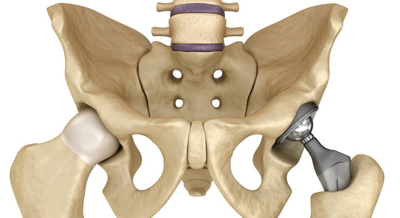 Computergestützte 3D Operationsplanung - OA Dr. Markus Winnisch, MSc - Orthopäde Wien 1090