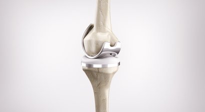 Knie- und Hüftendoprothetik (Einsatz eines künstlichen Knie- oder Hüftgelenks)