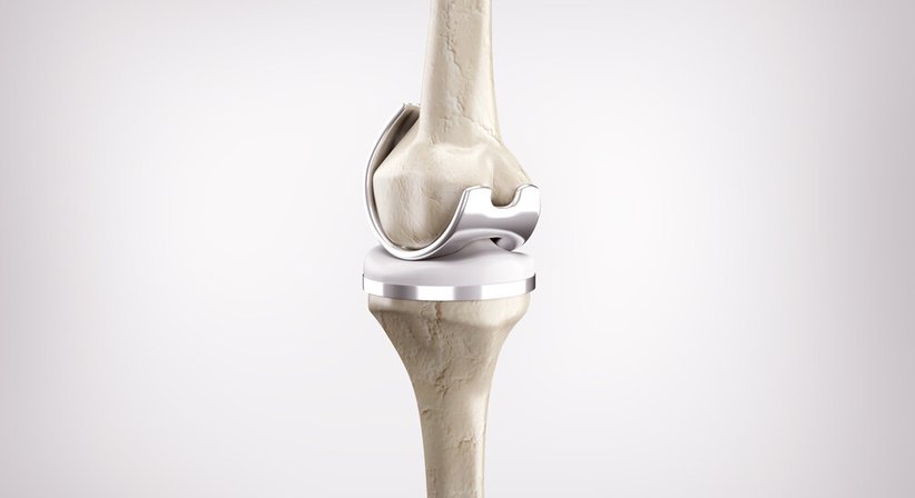 Knie- und Hüftendoprothetik (Einsatz eines künstlichen Knie- oder Hüftgelenks) - OA Dr. Markus Winnisch, MSc - Orthopäde Wien 1090