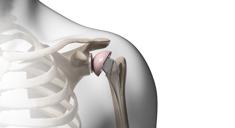 Schulterprothese (Einsatz eines künstlichen Schultergelenks) - OA Dr. Markus Winnisch, MSc - Orthopäde Wien 1090