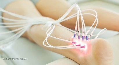 Laserneedle-Therapie