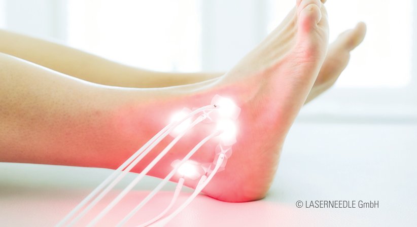 Laserneedle-Therapie - Dr. Thomas Laimer - Praktischer Arzt Leobersdorf 2544