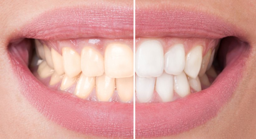 Bleaching - Dr. med. dent. Nikolaus Fürhauser - Zahnarzt Purkersdorf 3002