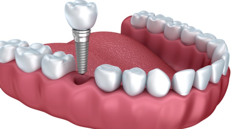 Implantologie - Dr. med. dent. Nikolaus Fürhauser - Zahnarzt Purkersdorf 3002