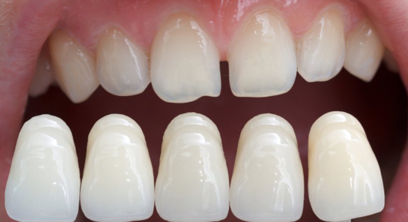 Veneers - Dr. med. dent. Nikolaus Fürhauser - Zahnarzt Purkersdorf 3002