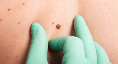 Muttermalkontrolle / Hautkrebsvorsorge