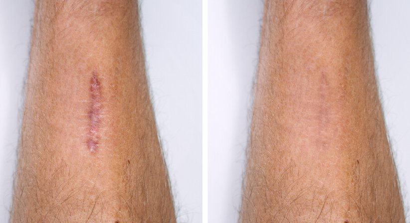 Narbenkorrekturen - Dr. Sedin Bajric - Orthopäde Wien 1030