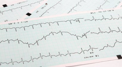 Herzrhythmusstörungen