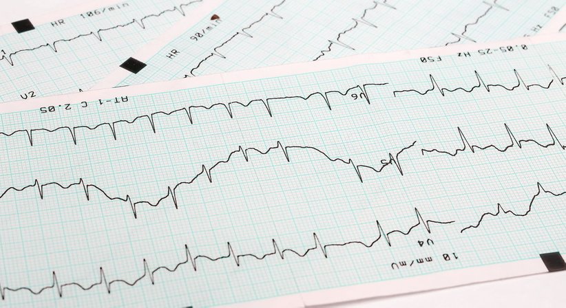 Herzrhythmusstörungen - Dr. Ivica Jukic - Internist Wien 1130