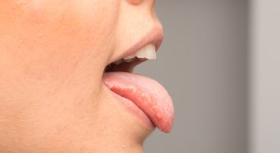 Erkrankungen der Speicheldrüse