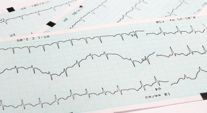 Herzrhythmusstörungen