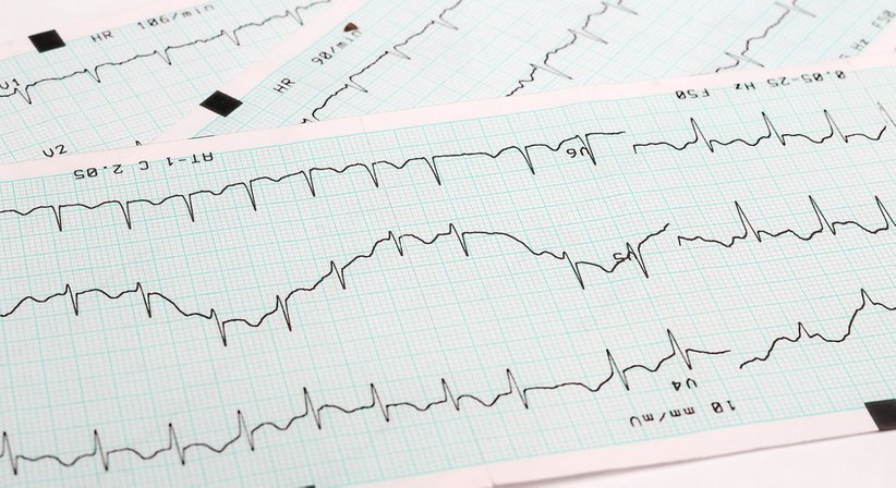 Herzrhythmusstörungen - Dr. Ivica Jukic - Internist Mödling 2340